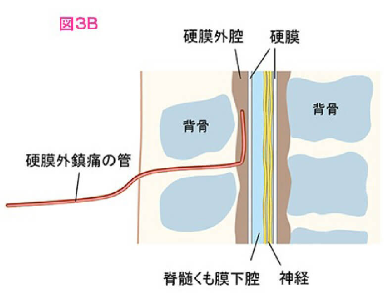 図3B 背骨の周辺を拡大